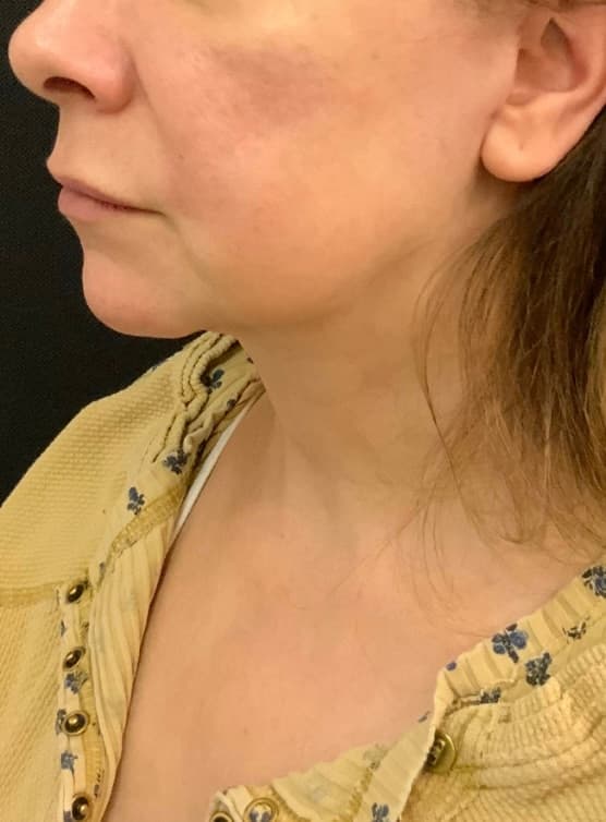 After facelift and neck lift, right side view — a patient of Dr. George Ferzli, New York