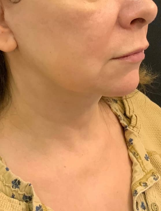 After facelift and neck lift, right front oblique view — a patient of Dr. George Ferzli, New York