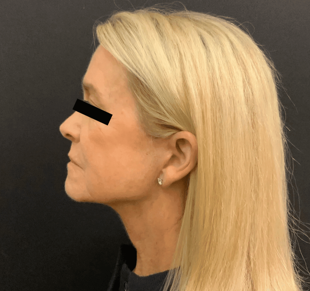 After facelift, necklift, browlift, left side view — a patient of Dr. George Ferzli, New York