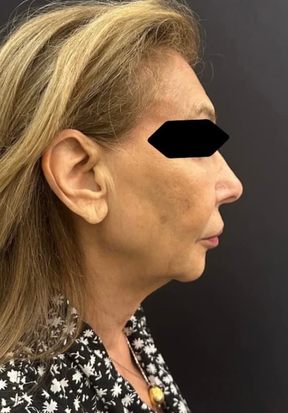 Before facelift and neck lift, right side view — a patient of Dr. George Ferzli, New York