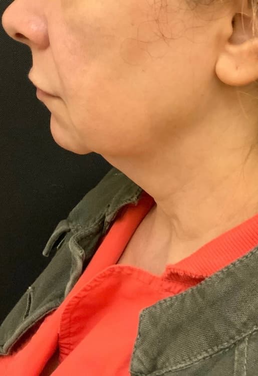 Before facelift and neck lift, front view — a patient of Dr. George Ferzli, New York