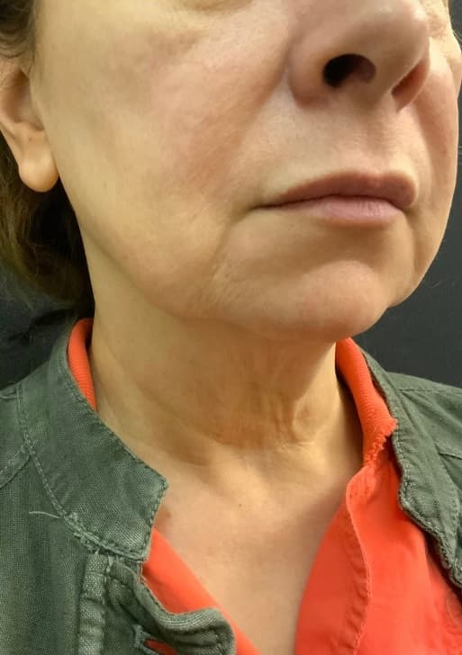 Before facelift and neck lift, right front oblique view — a patient of Dr. George Ferzli, New York