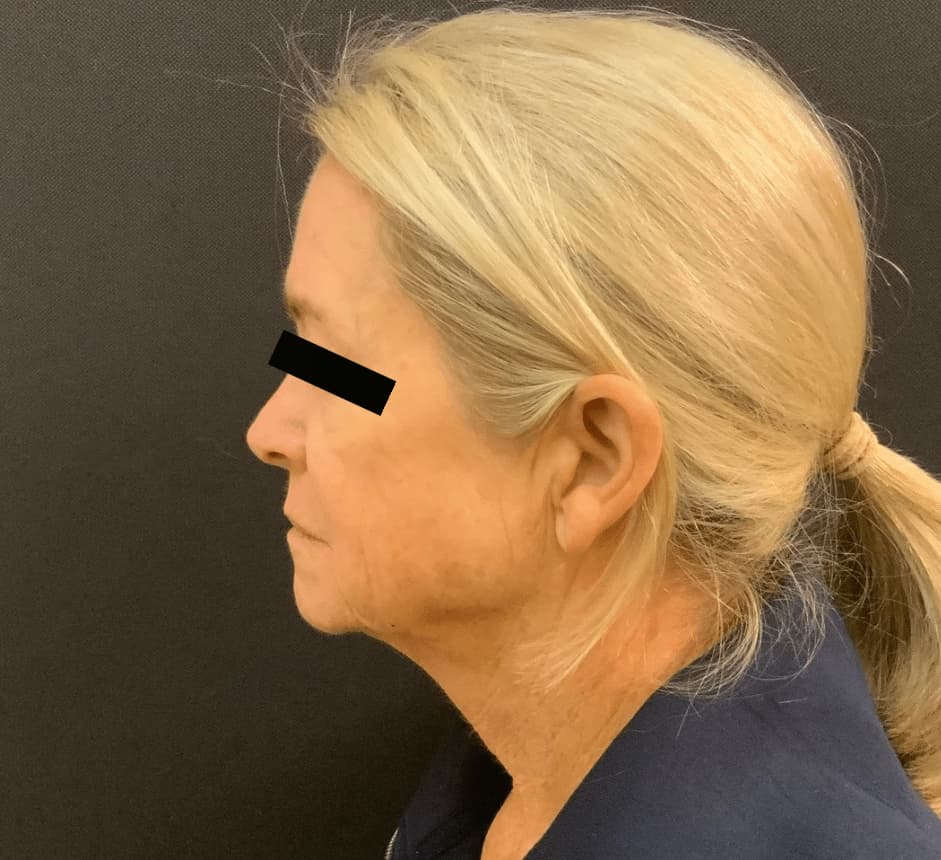 Before facelift, necklift, browlift, left side view — a patient of Dr. George Ferzli, New York